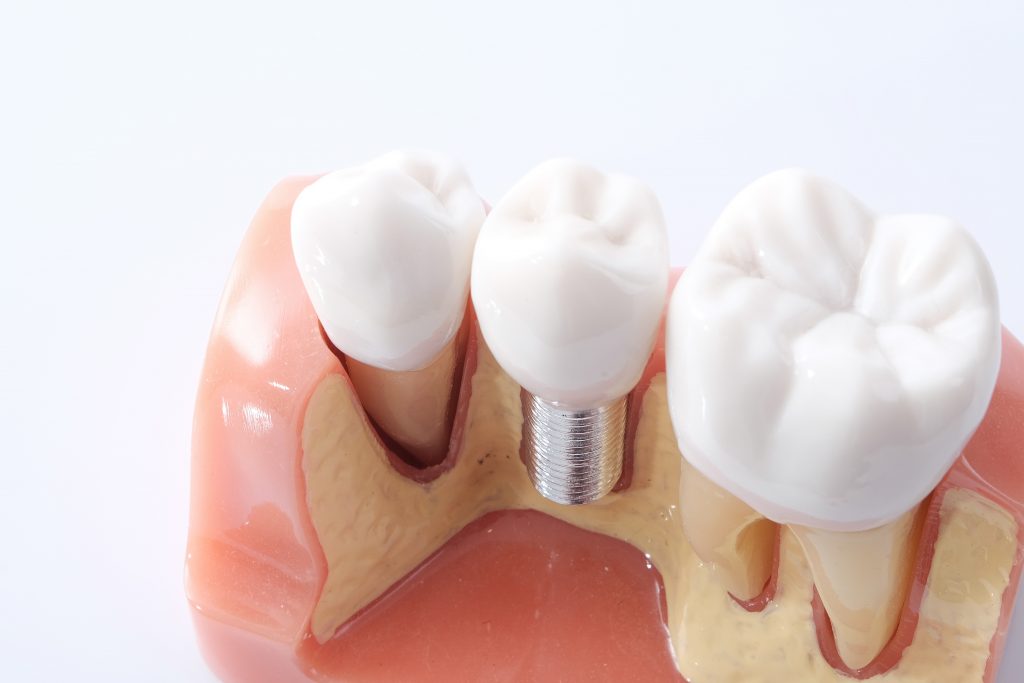 Implantedente-dentista-saopaulo