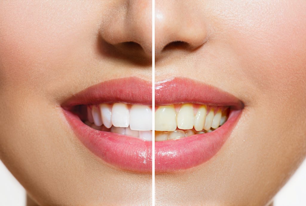 clareamentodente-dentista-saopaulo